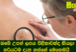 ඔබේ උපන් ලපය පිළිකාවක්ද කියලා හරියටම දැන ගන්නේ මෙහෙමයි.